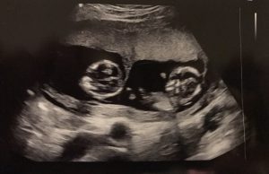 12 week scan pic which shows there are twins