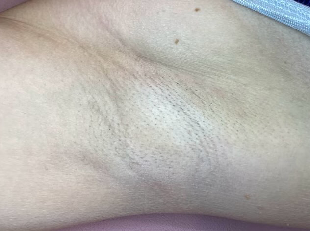 An armpit having had laser hair removal in Plymouth